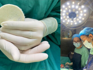 Con parches de placenta humana, logran cicatrizar una herida compleja